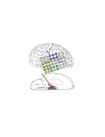 Epilepsy Treatment